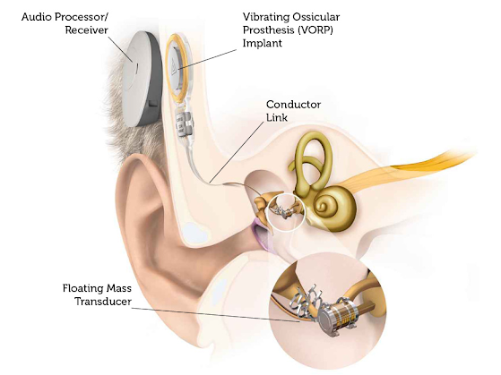 Ear Implants Illustration