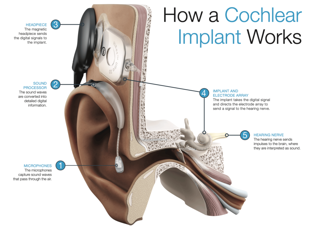 Cochlear Implant: Trusted Service Provider in Singapore